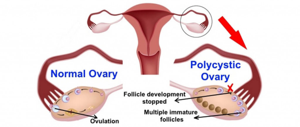 PCOS and the Likelihood of Having a Boy or Girl